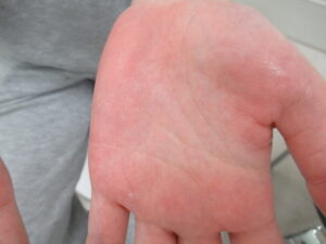 手掌多汗症　左　光って手の汗が見えています。